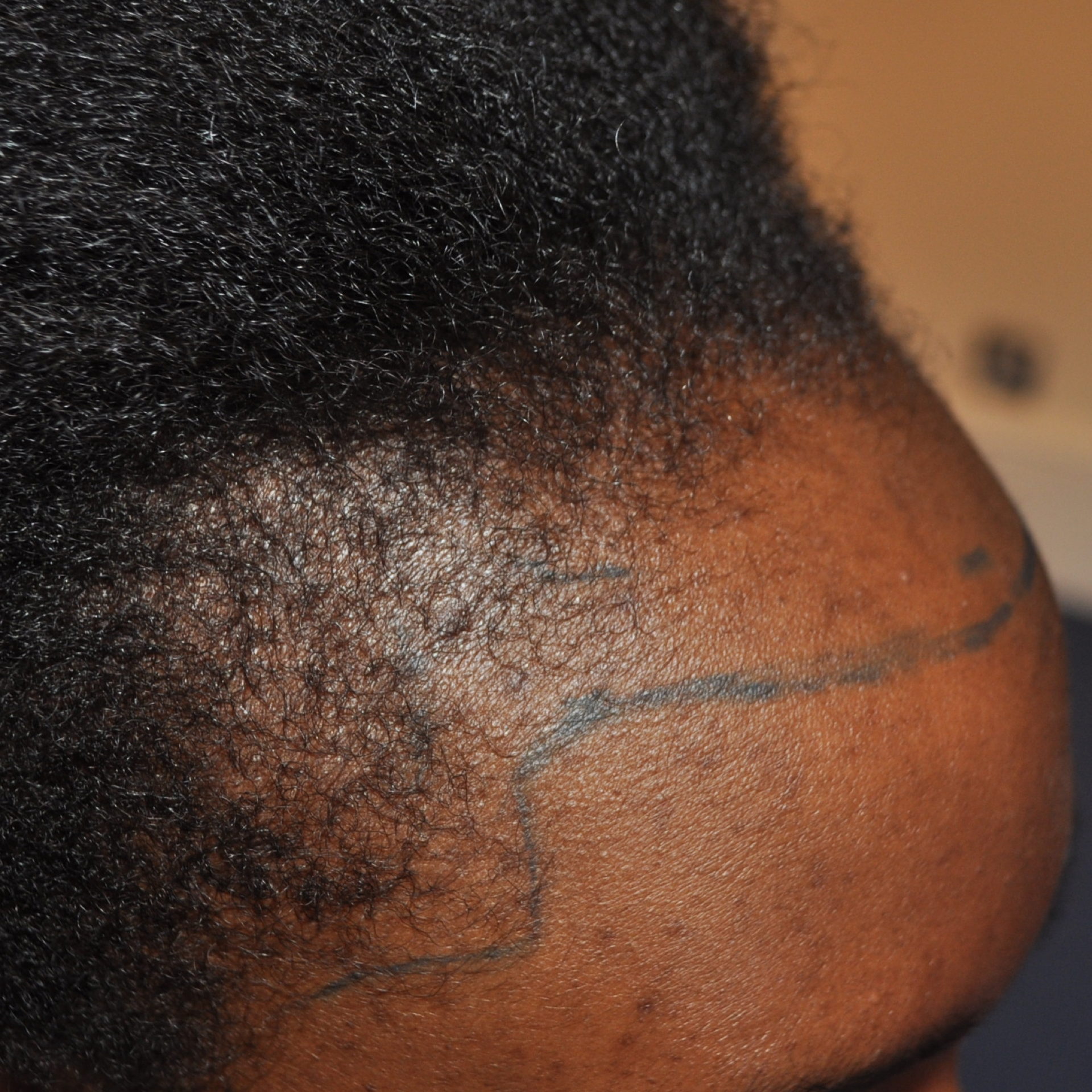 Afro Hair Transplant, Wimpole Clinic