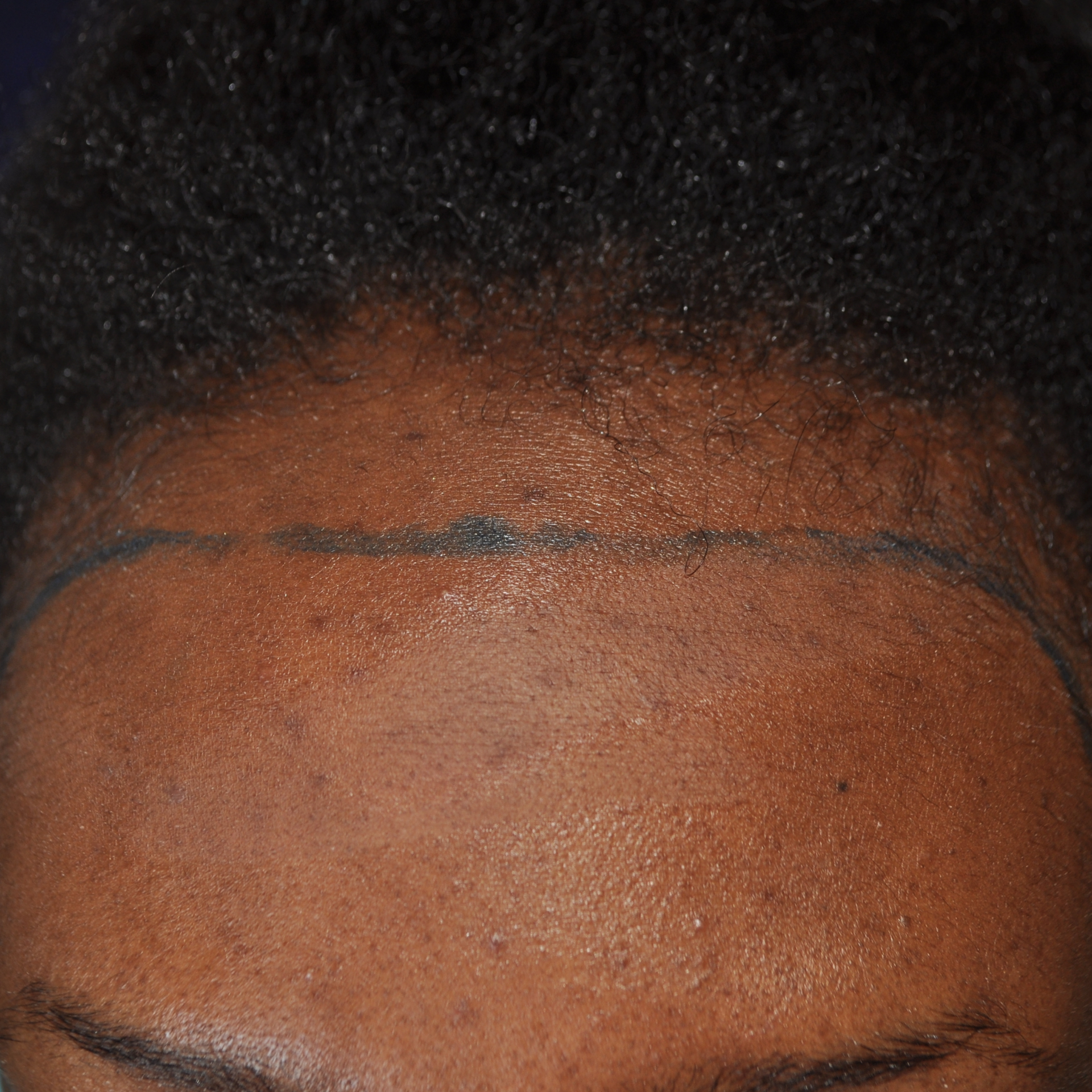 Afro Hair Transplant, Wimpole Clinic