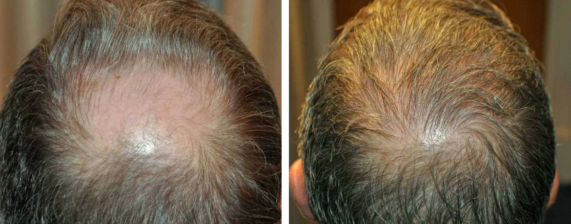 1800 grafts hair transplant on the crown before and after 14 months