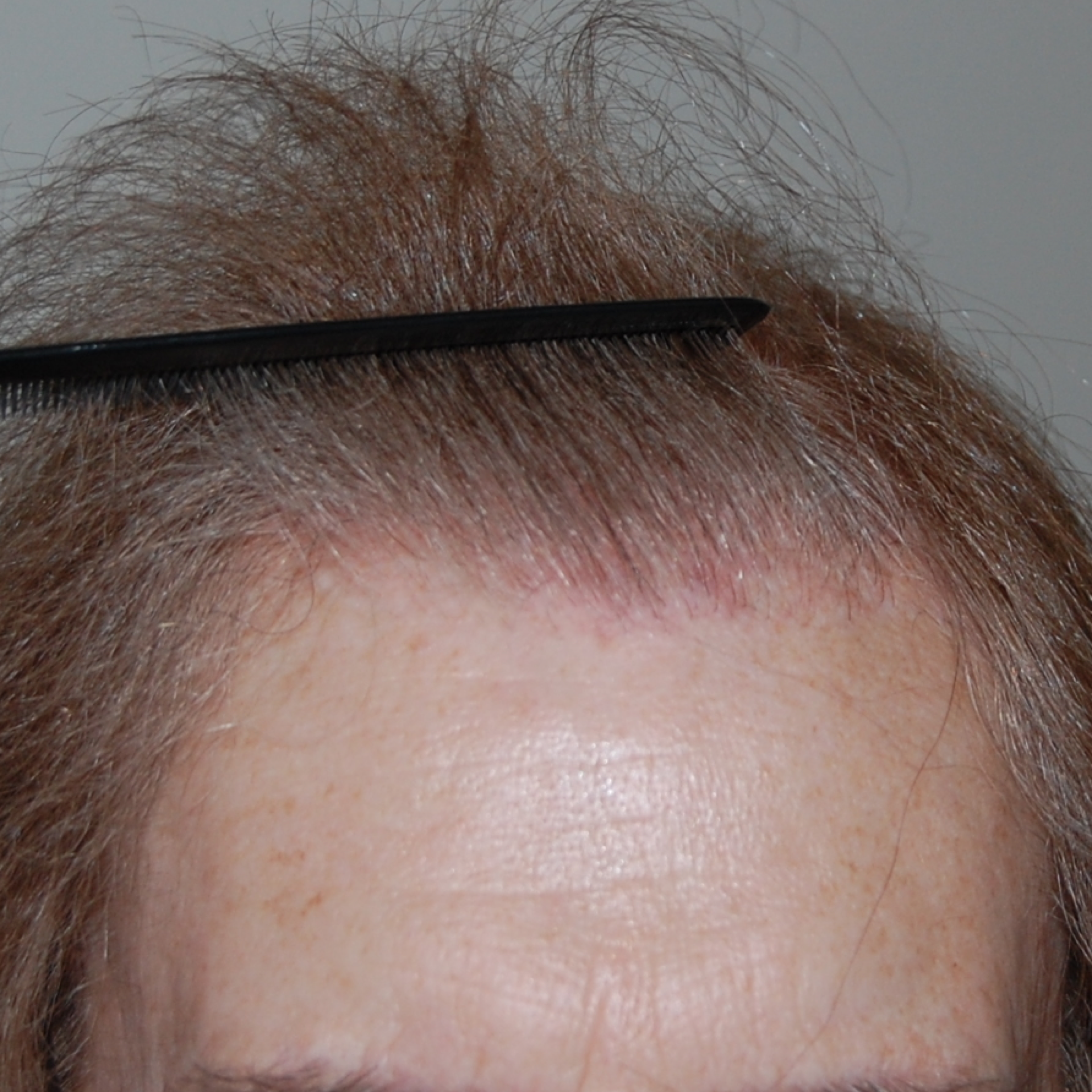 Female Hair Transplant, Wimpole Clinic