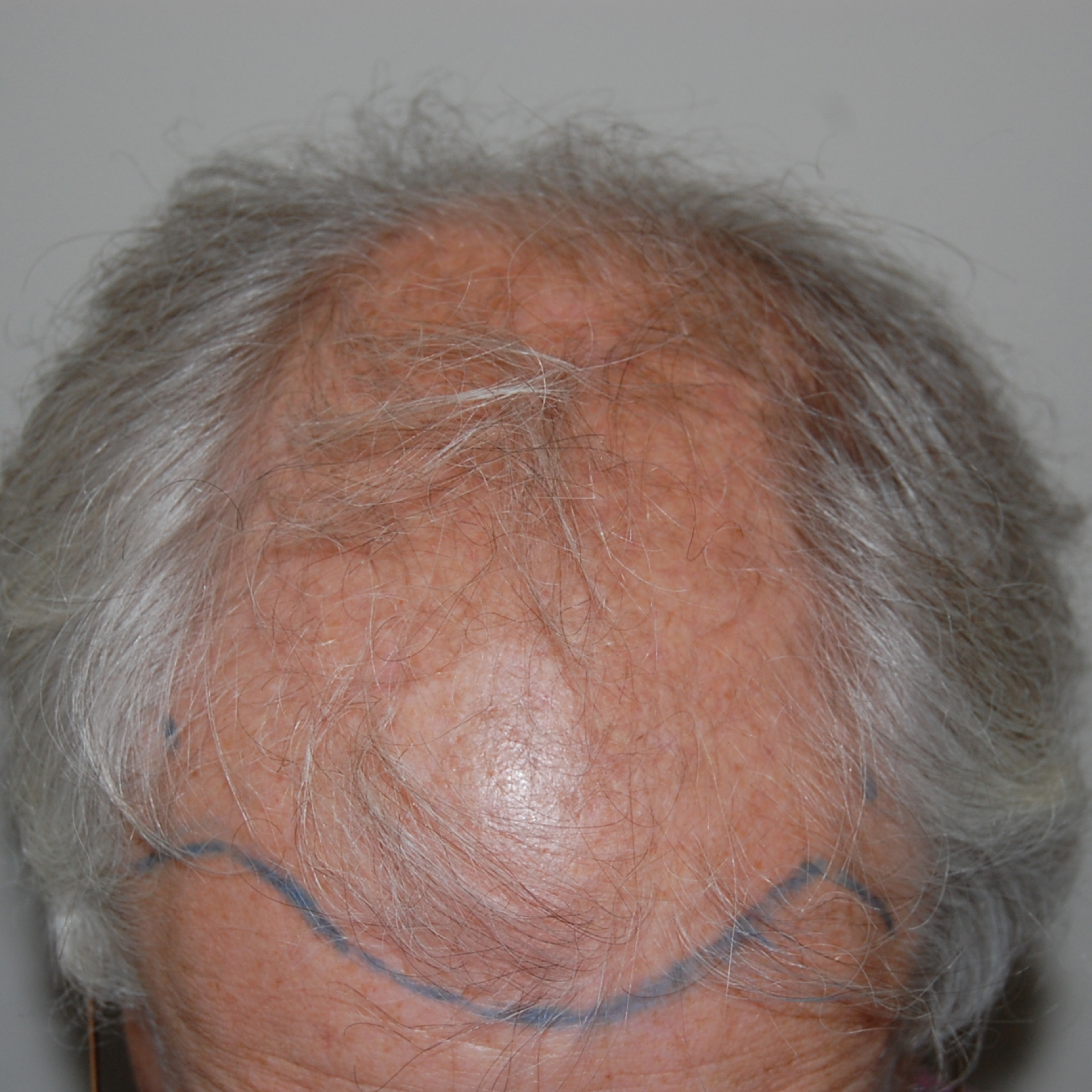 Female Hair Transplant, Wimpole Clinic