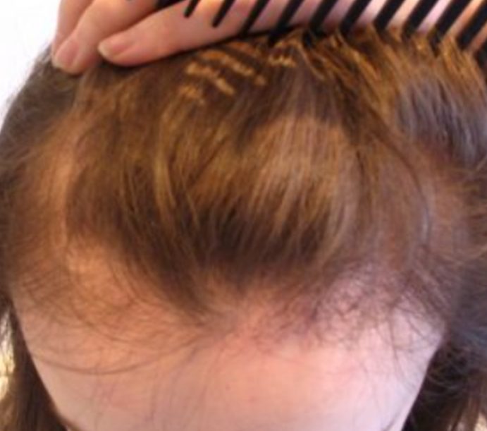 Female Hair Transplant, Wimpole Clinic