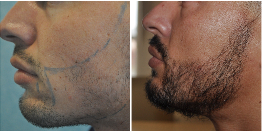 Before and after beard transplant