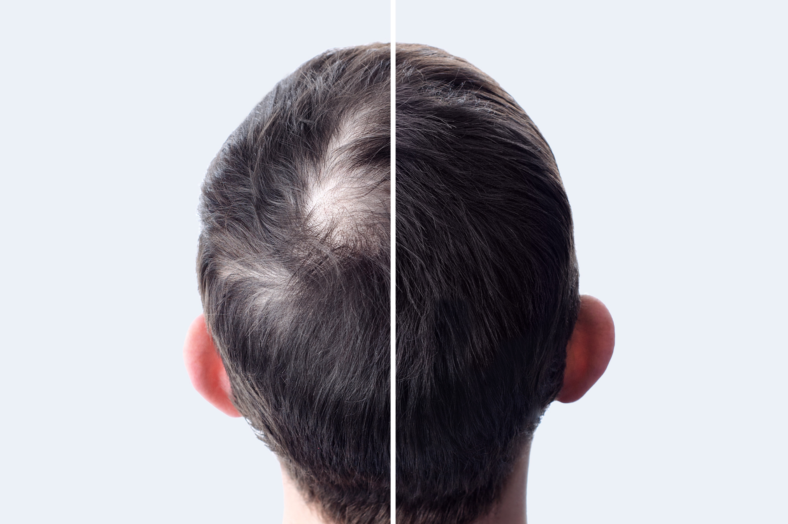 Before and after using hair thickening powder to cover bald spot on the crown