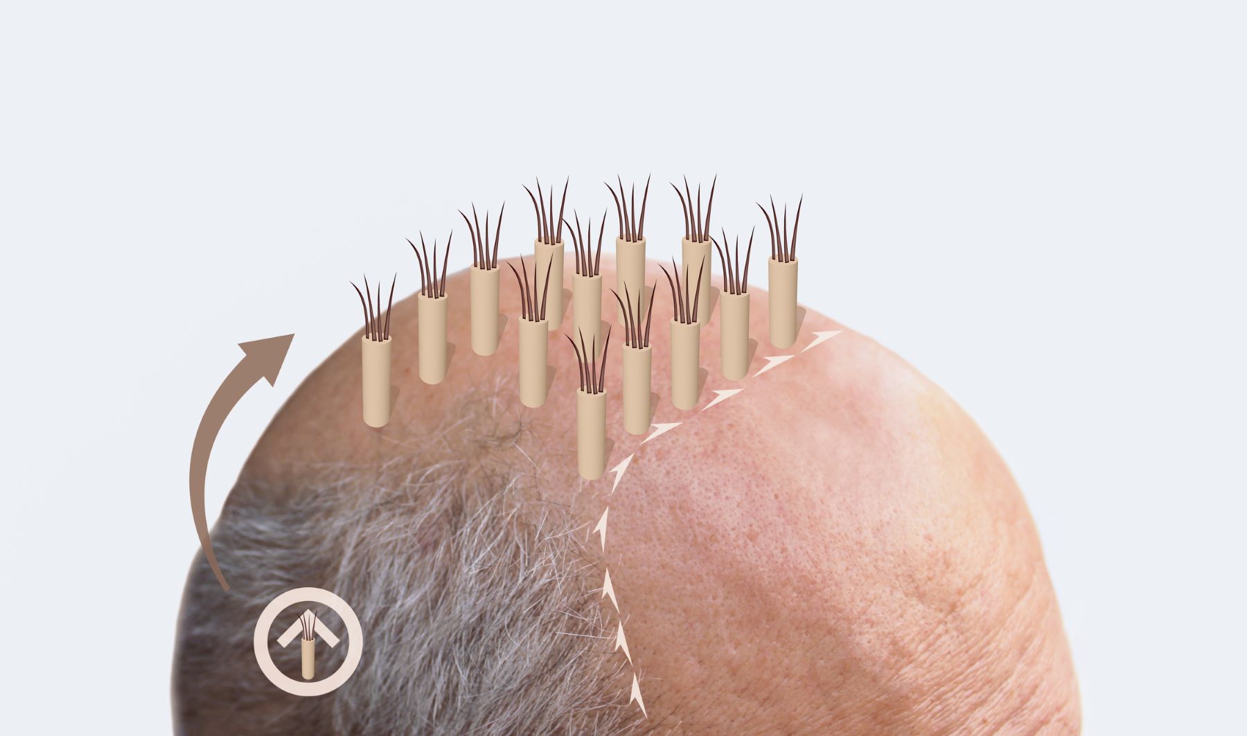 FUE full head hair transplant process