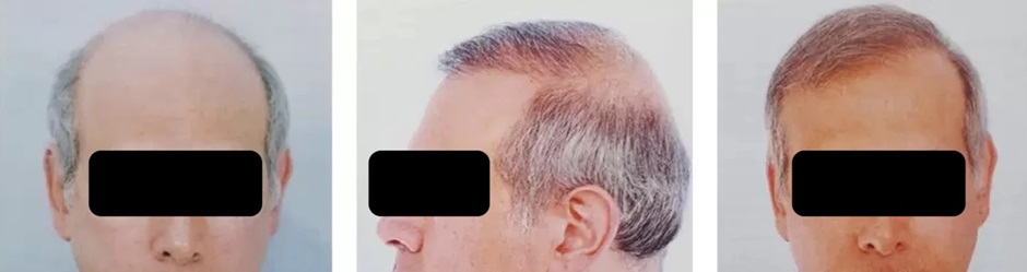 Norwood 7 FUE hair transplant