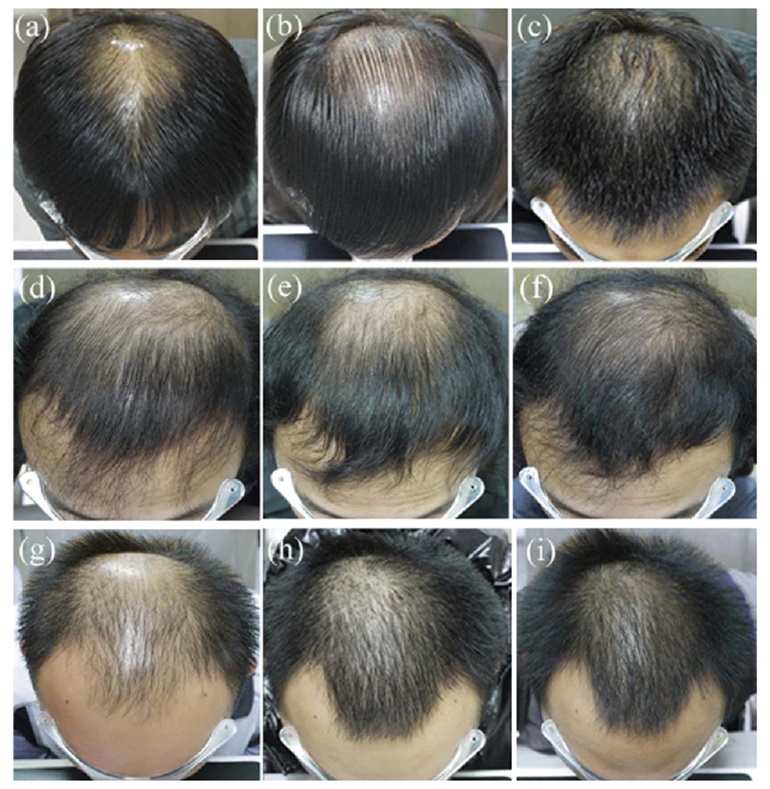 Images showing 3 patients treated with Finasteride, Minoxidil, and a combination of the 2 drugs at baseline, 6 months, and 12 months.