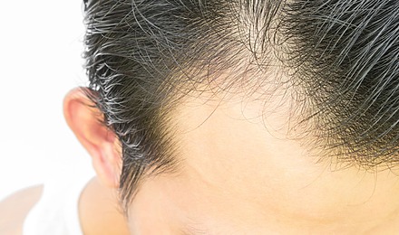 Man Affected By Finasteride Shedding