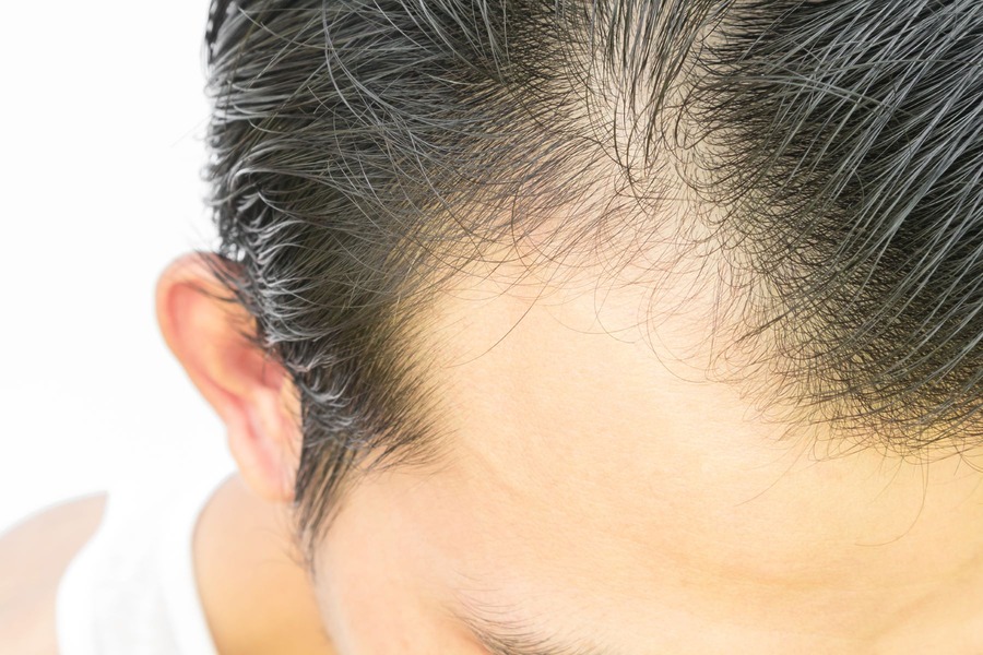 Man Affected By Finasteride Shedding