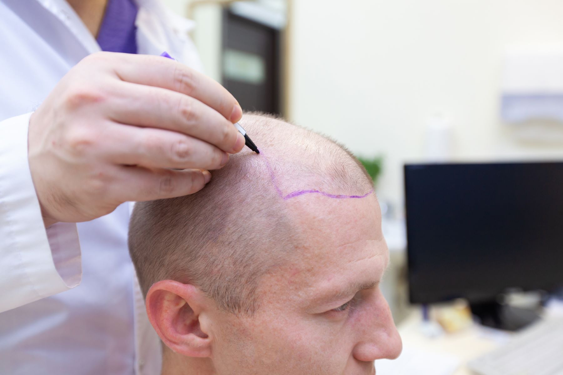 Preparing for a hair transplant