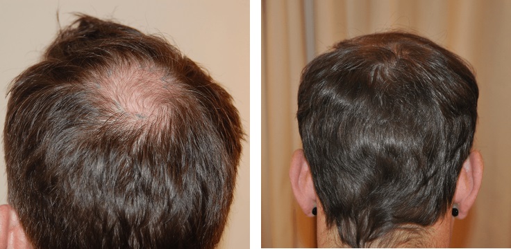 800 grafts FUE hair transplant UK