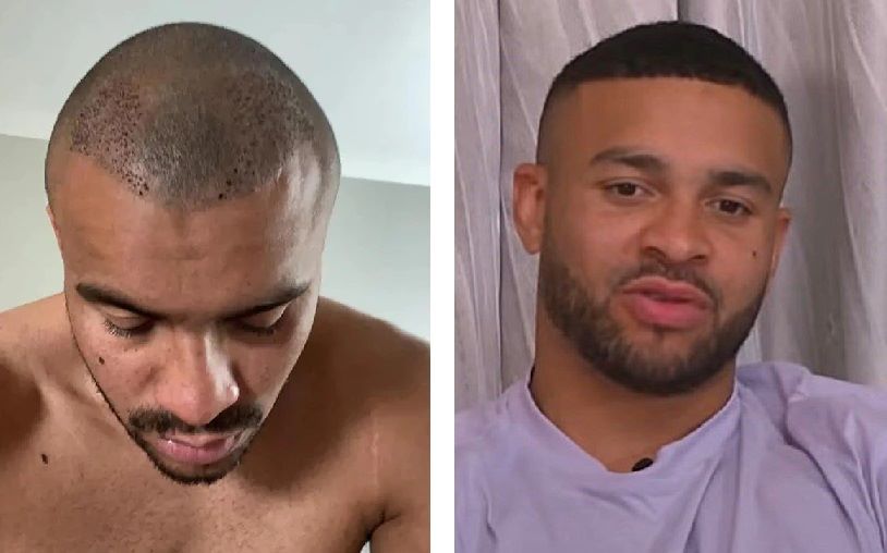 Jonathan Joseph hair transplant at the Wimpole Clinic