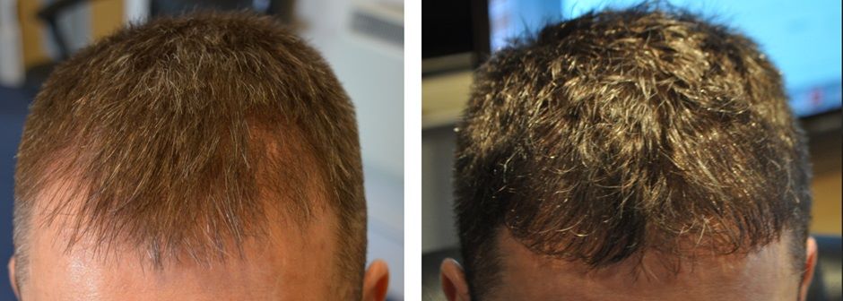 Man before and after a hair transplant at the Wimpole Clinic