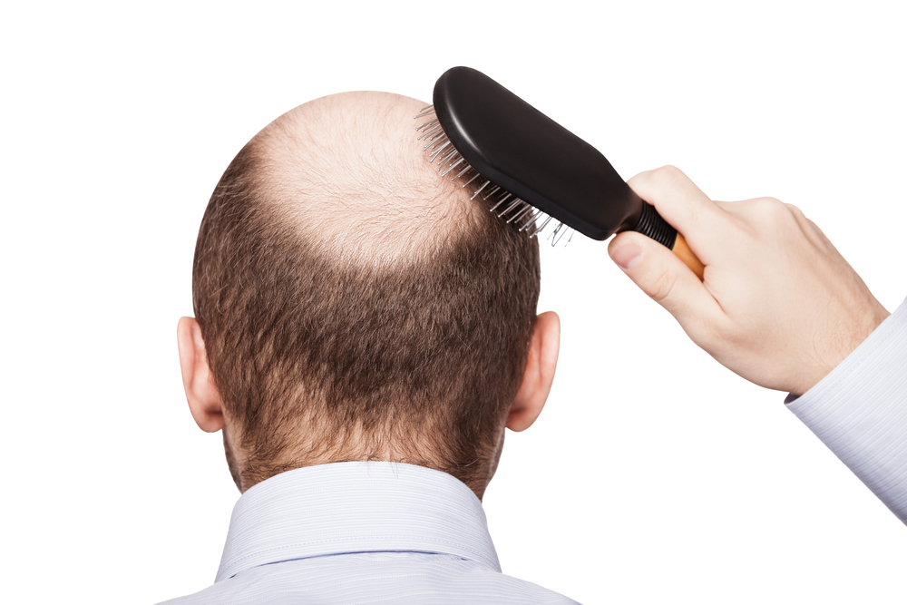 man with male pattern baldness