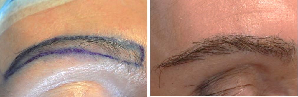 Wimpole patient before and after eyebrow hair transplant