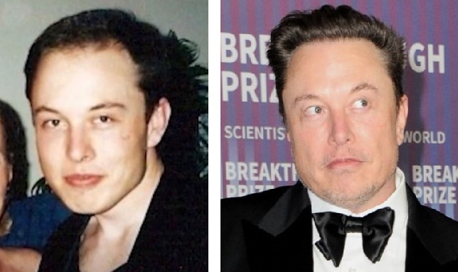 Elon Musk hair transplant