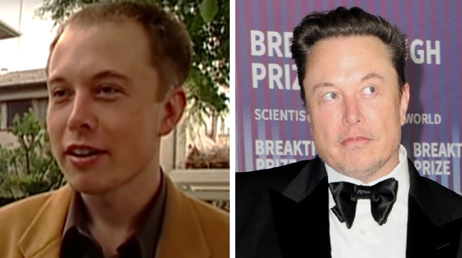 Elon Musk before and after hair transplant