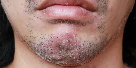 man with beard psoriasis