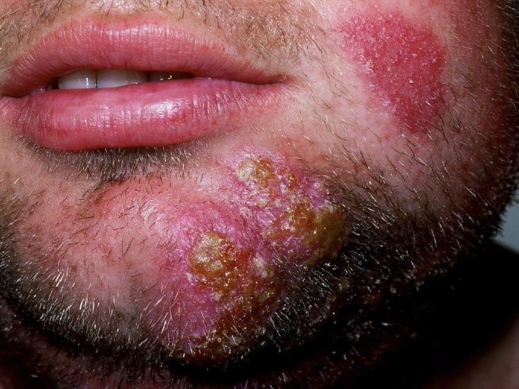 man with beard ringworm