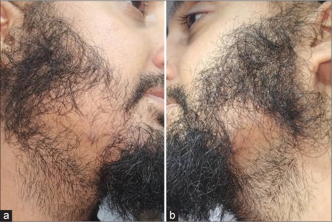 man with beard traction alopecia