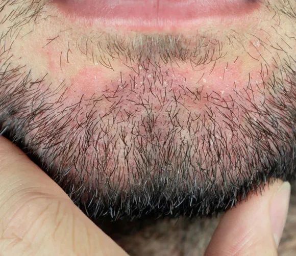 man with seborrheic dermatitis of the beard