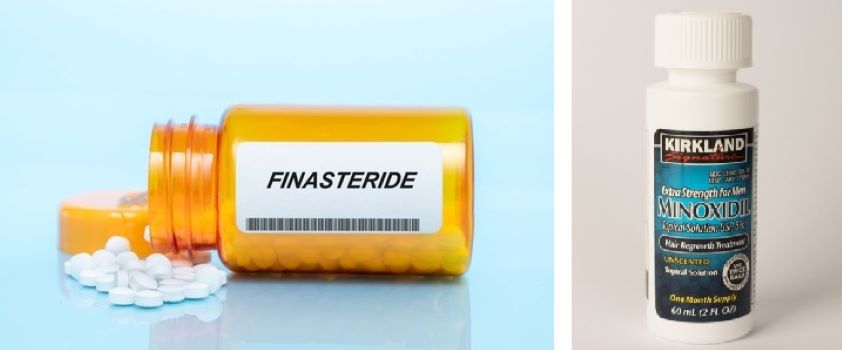 Minoxidil vs finasteride for hair loss