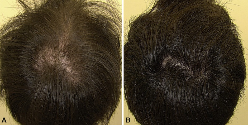 Minoxidil before and after