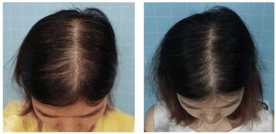 Minoxidil for women before and after