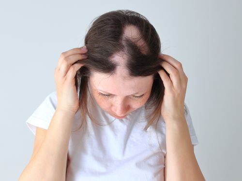 Alopecia areata on one side of head