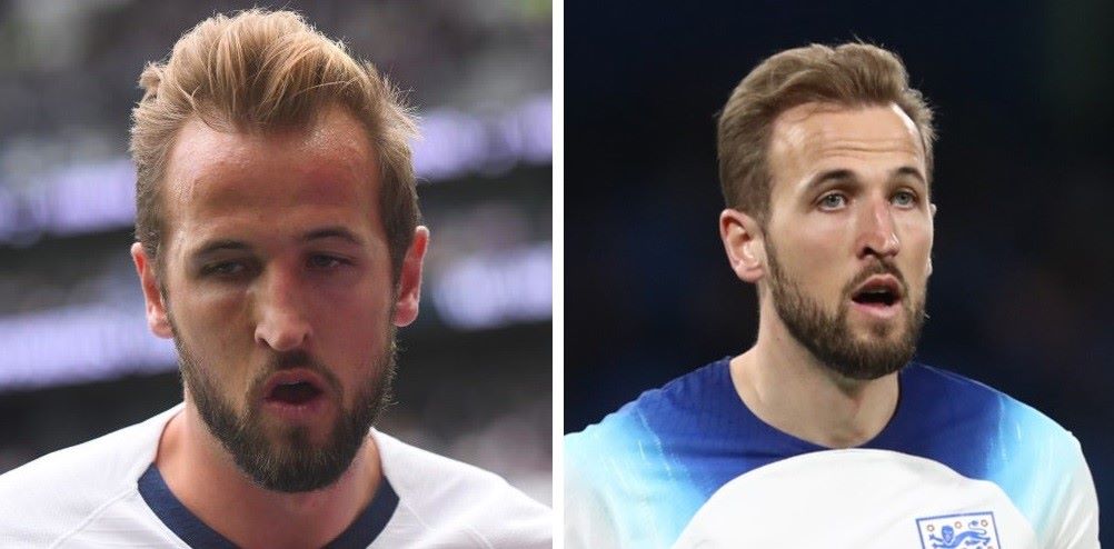 Harry Kane with hair loss (left) and fuller hair (right)