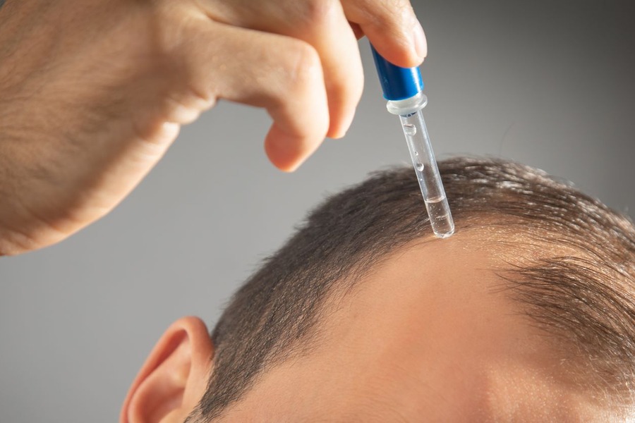 Minoxidil For A Receding Hairline: Benefits, Risks, Results