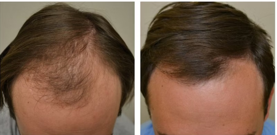 Patient before and after Minoxidil treatment