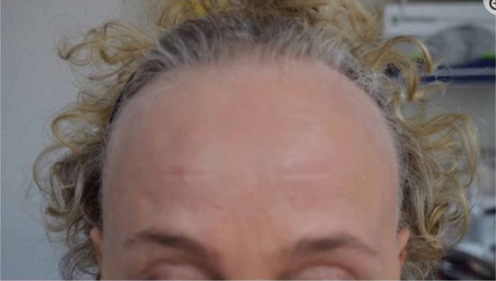 Receding hairline from alopecia areata