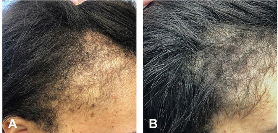 Traction alopecia before and after Minoxidil treatment