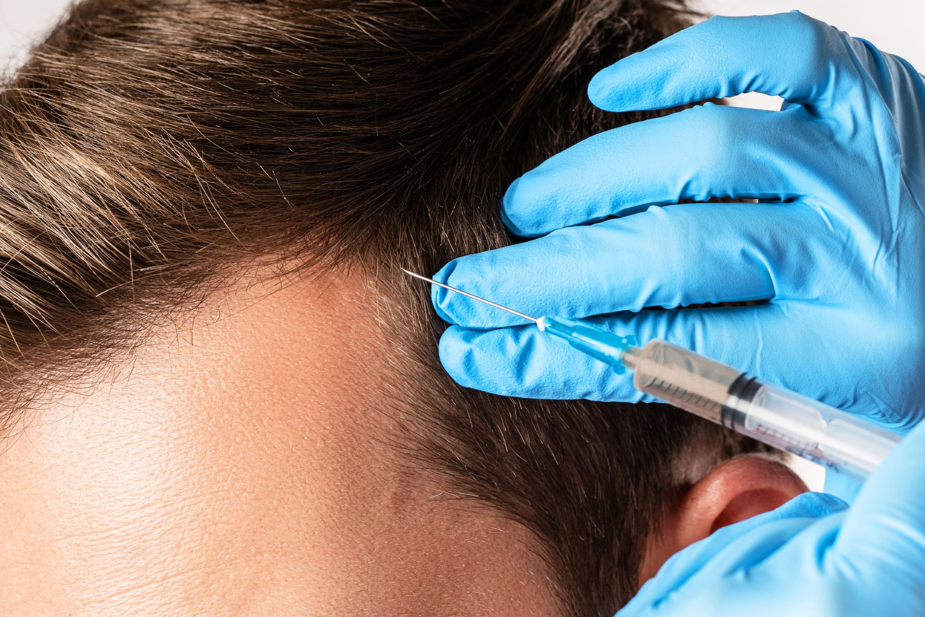 Treatment alternatives to Minoxidil