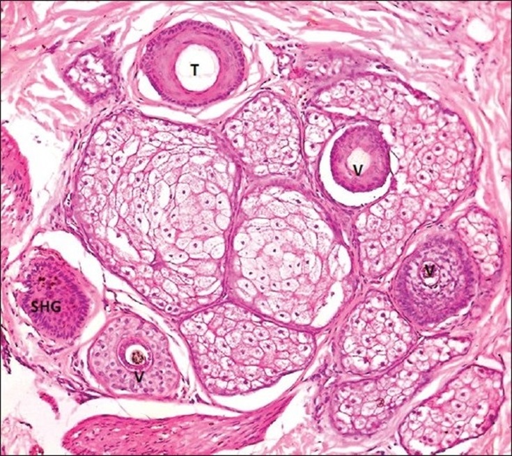 Androgenetic alopecia revealed by a scalp biopsy