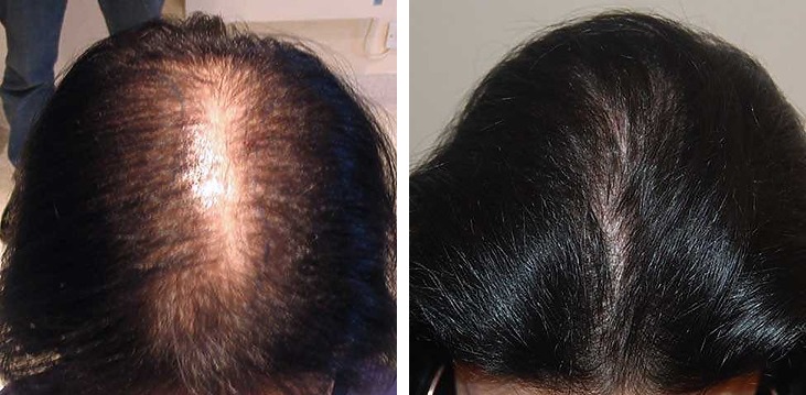 Female hair transplant at the Wimpole Clinic