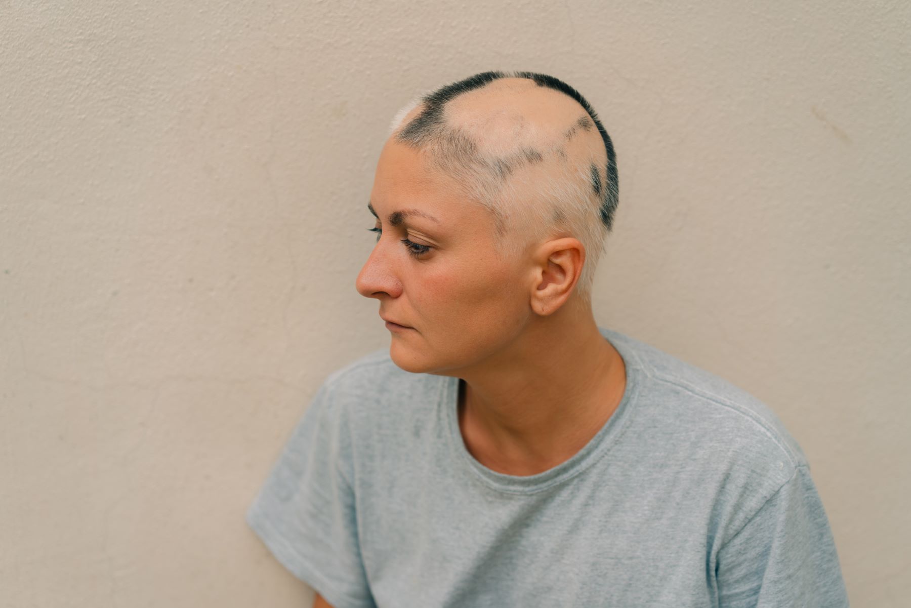 Alopecia areata