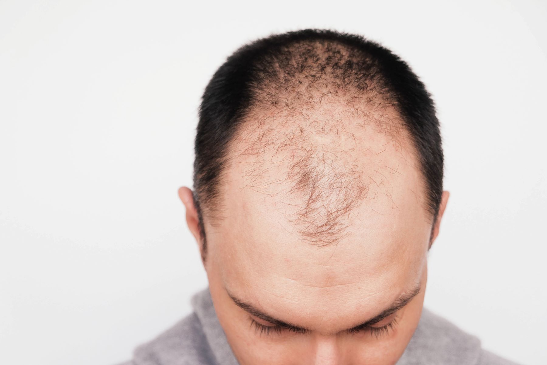 Androgenetic alopecia