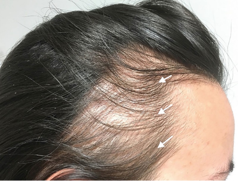 Traction alopecia