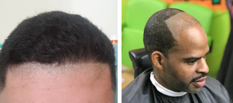 Examples of bad haircuts causing a bad hairline