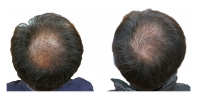 Patient hair regrowth before and 24 weeks after daily pumpkin seed oil supplementation