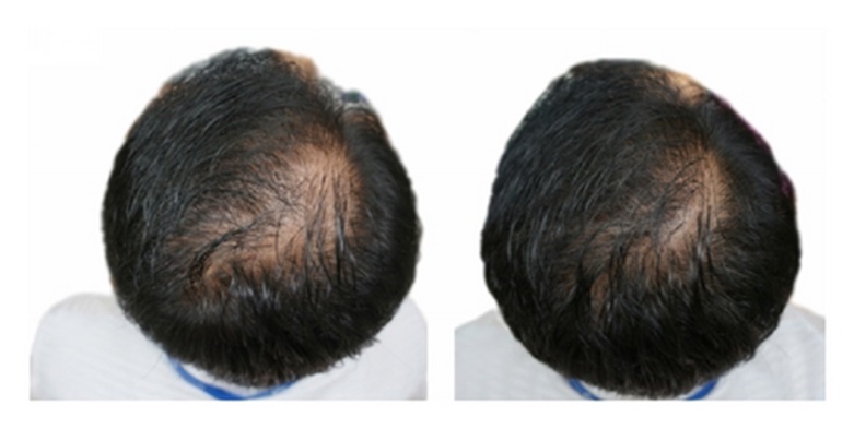 Patient hair regrowth before and 24 weeks after daily pumpkin seed oil supplementation