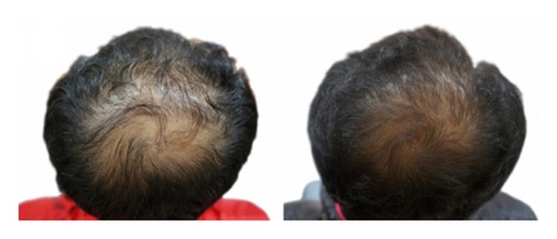 Patient hair regrowth before and 24 weeks after daily pumpkin seed oil supplementation