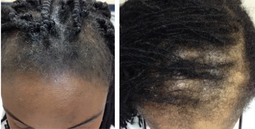 hair loss and hair thinning due to traction alopecia