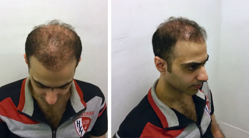 Are hair transplant worth it