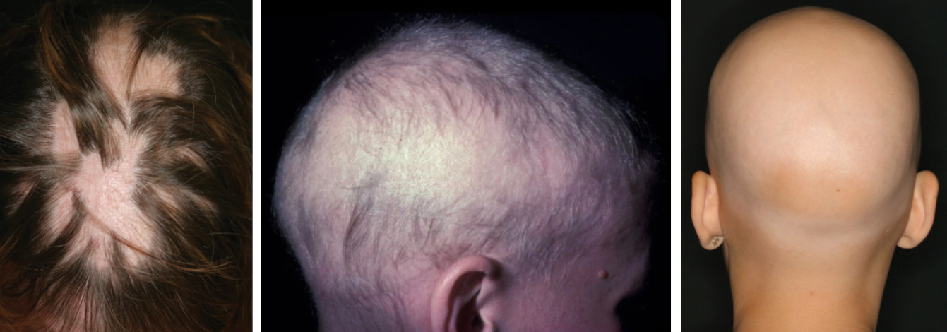 Alopecia totalis