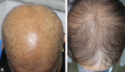 Diffuse alopecia