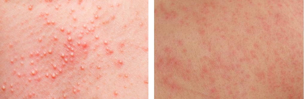 Red contact dermatitis rash examples