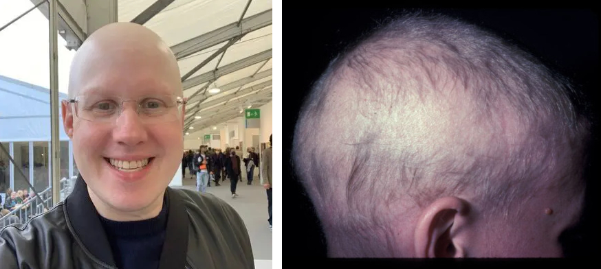 alopecia totalis